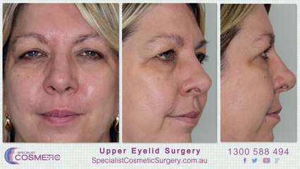 An Overview of Upper Eyelid Surgery