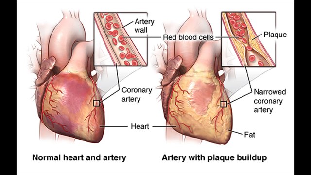 Dr Manish Bansal MD Jacksonville Fl talks on Congestive Heart failure & Acute Myocardial Infarction