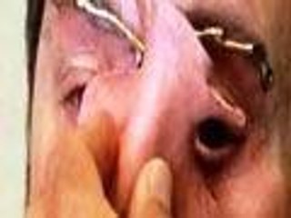 The Man Who Gave Up His Face: To Save His Life