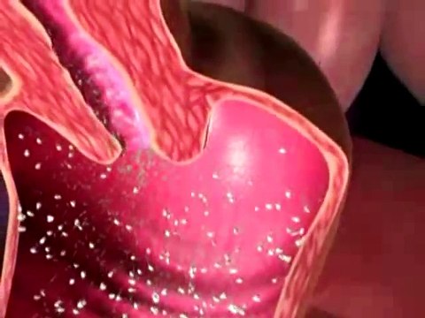 La résistante aux antibiotiques favorise la prolifération de trois infections sexuellement transmissibles (IST)