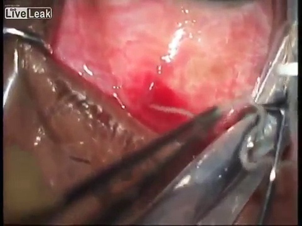 remover 45cm de algo no olho