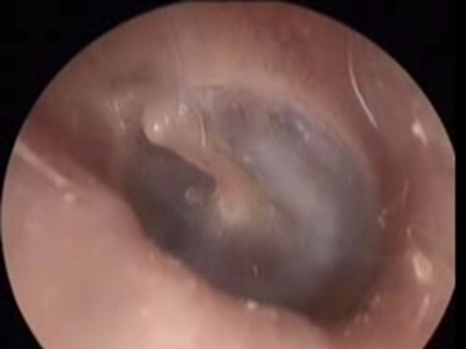 Conduit auditif Renaud BEIX Audioprothésiste CHALONS EN CH