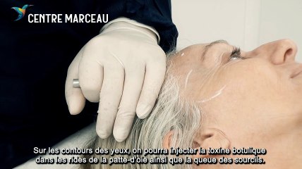 Traitement des rides d'expression par la toxine botulique