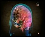 TCE: Hemorragia cerebral (Autopsia forense)