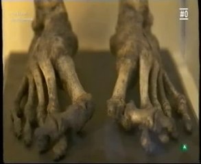 Acido urico (Gota): La dieta del emperador Carlos V