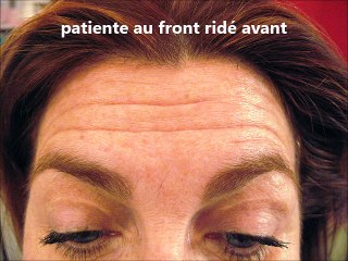 botox injections en 2 fois, par vladimir mitz