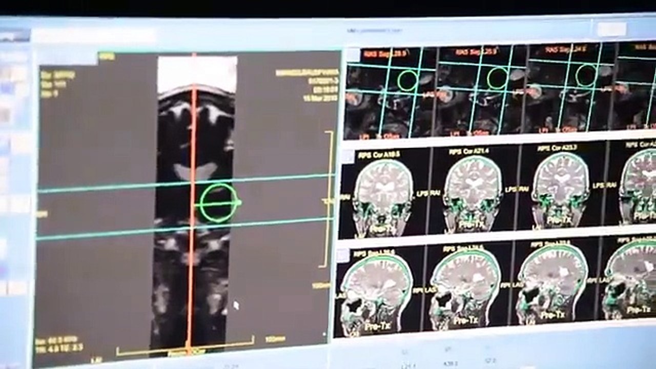 ISRAELE INVENTA LA CHIRURGIA CHE ELIMINA IL TREMOLIO DEL PARKINSON