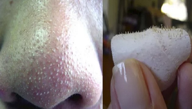 How To Get Rid Of Blackheads On Nose Fast At Home