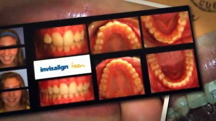 Invisalign Las Vegas