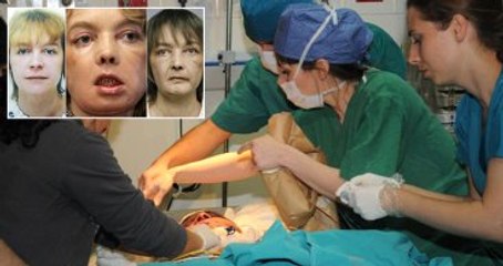 İlk Kısmi Yüz Nakli Gerçekleştirilen Fransız Kadın Öldü