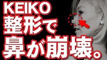 【閲覧注意】globe KEIKOの鼻がヤバいことになっている・・・整形の後遺症・・・？？【悲報】