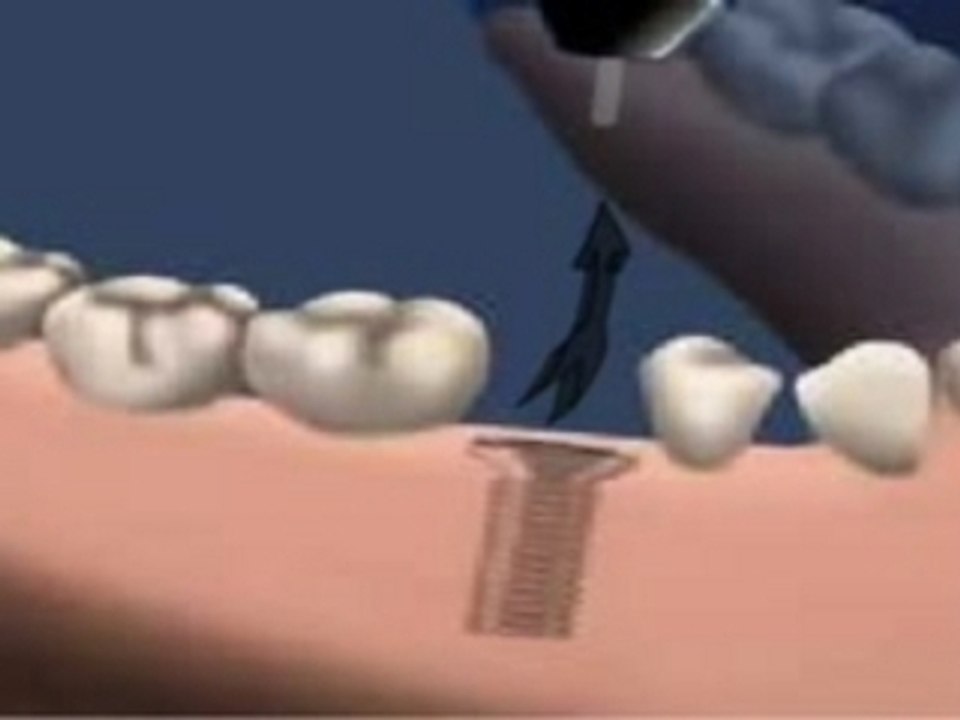 étapes de la pose d'un l'implant