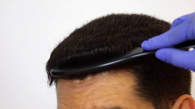 Hair Transplant in Los Angeles - Best FUE Hair Restoration Los Angeles, Beverly Hills, San Francisco