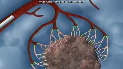 Eliza Mioma: Causes and Treatment Options