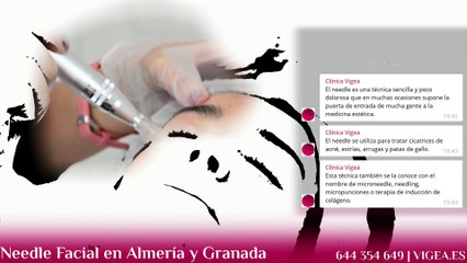 Needling en Granada y Almería