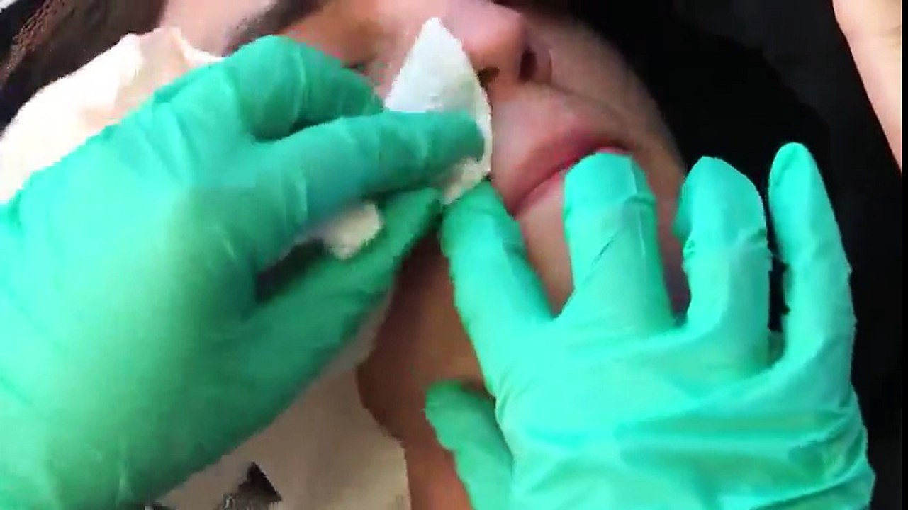 Removing Cyste