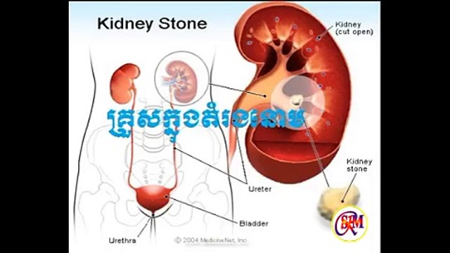 ក្រូសក្នុងតំរងនោម, Khmer Health, Health Cambodia, Kidney Stone
