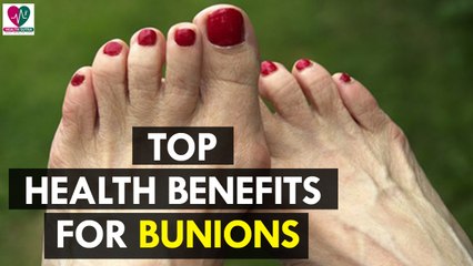 Home Remedies for Bunions - health Sutra