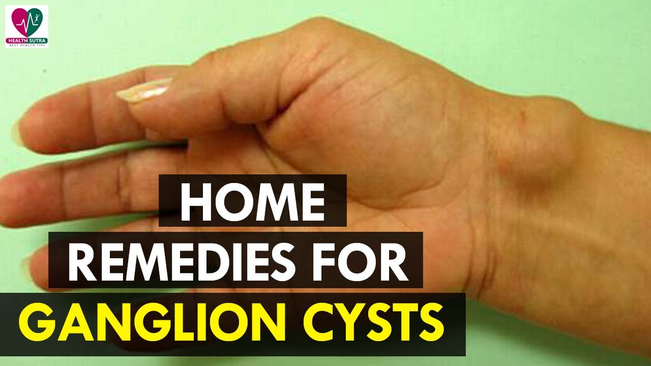 Home Remedies for Ganglion Cysts - Health Sutra
