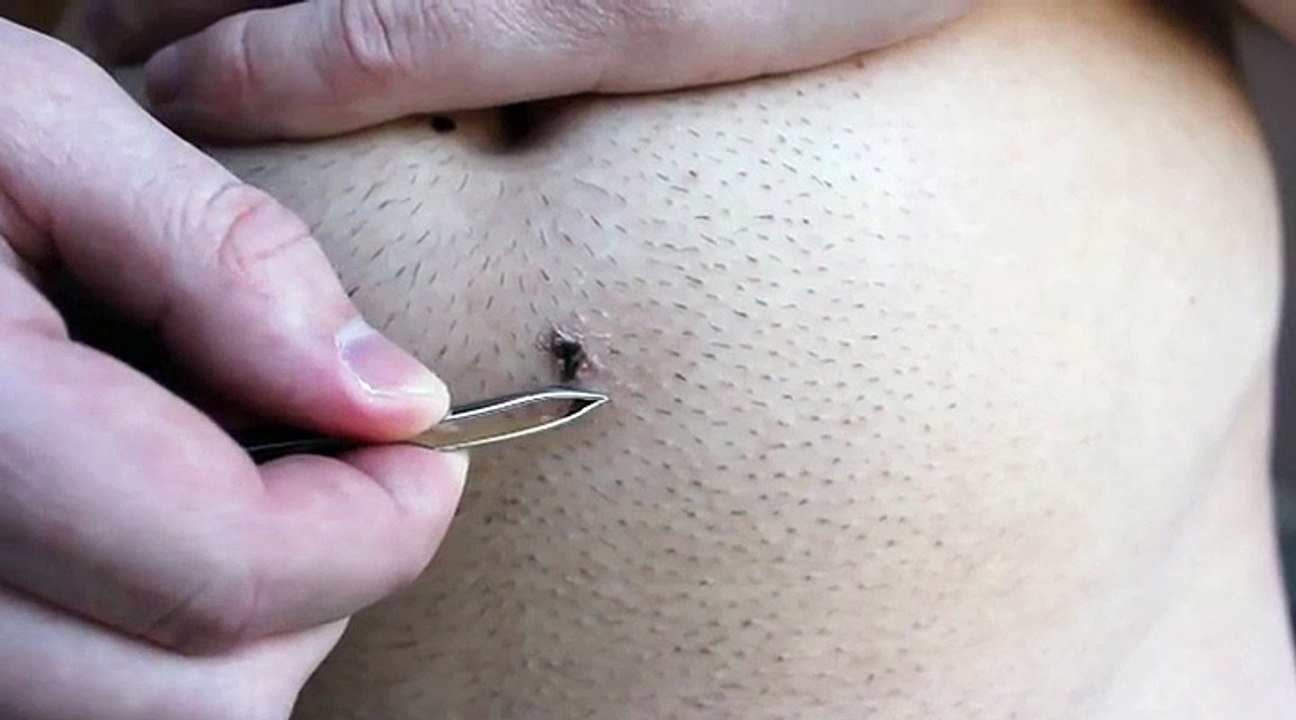 Le poil incarné le plus long du monde... Ouahhhh