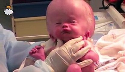 Ce petit bébé est né avec la tête très gonflé. 20 mois plus, voici ce qu'il est devenu!