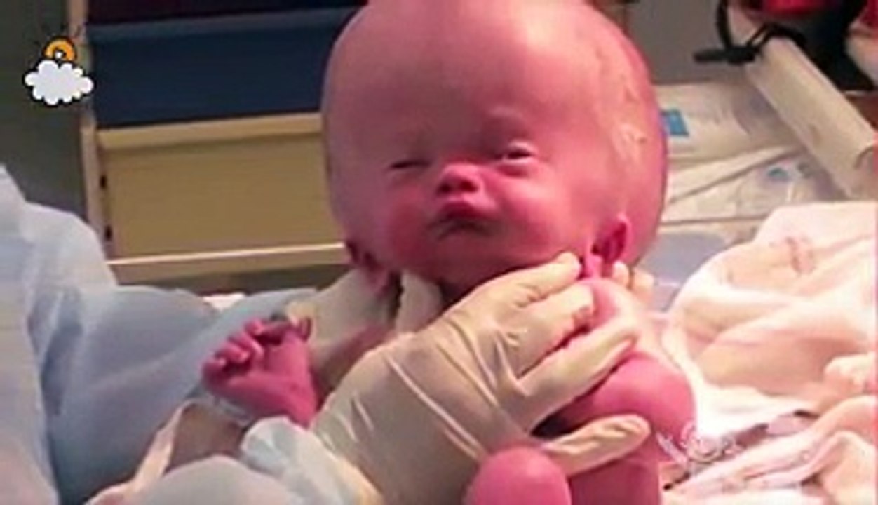Ce petit bébé est né avec la tête très gonflé. 20 mois plus, voici ce qu'il est devenu!