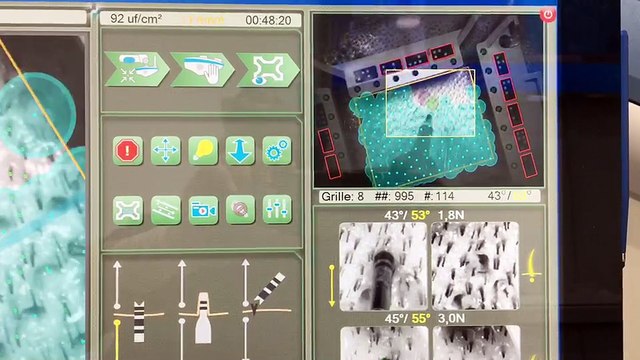 1000 UF prélevés en 48 mn The-Clinic Paris robot Artas