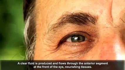 Open-angle Glaucoma