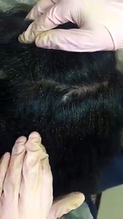 Eso no son piojos, es ¡un nido de piojos!. ¿Cómo dejan así a la niña?