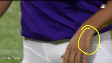 Sam Bradford Gets Hand Injury Do To A Hit by Clay Matthews!