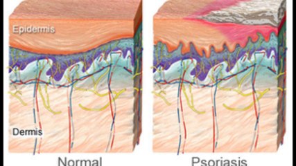 Understanding Psoriasis: Causes, Treatments & Legal Updates in Jacksonville 🩺