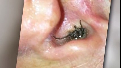 Rùng mình trước cảnh nhện chui ra từ lỗ tai