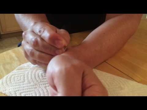 Masochist Uses Fish Hook and Push Pin to Pop Cyst