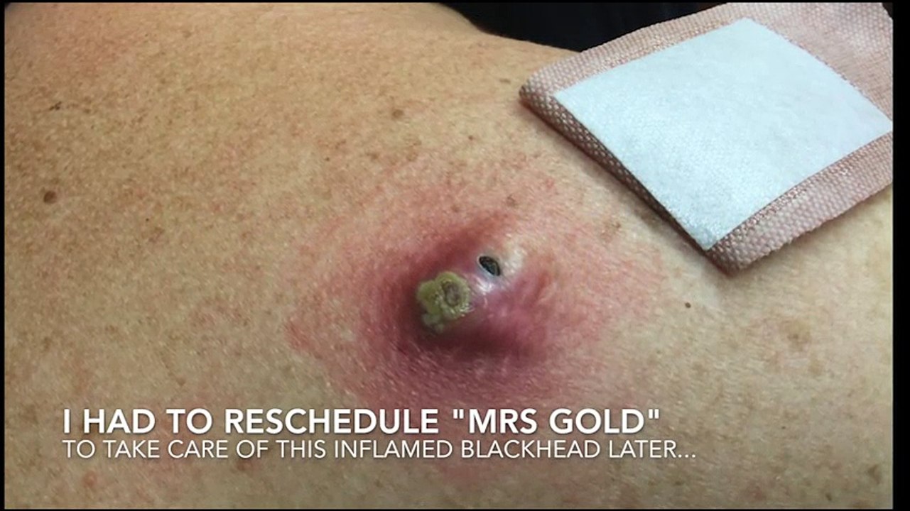 Cảnh nặn mụn thu hút hơn một triệu lượt xem trong 1 ngày