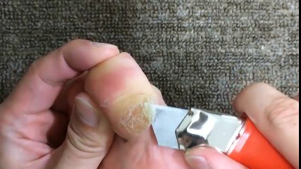 Cận cảnh màn cắt da sần coi xong... muốn coi tiếp