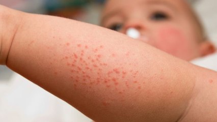 Yeast Infection Diaper Rash Treatment