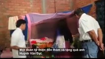 Xót thương người đàn ông ở Tiền Giang còn 1 nửa khuôn mặt vì bệnh lạ