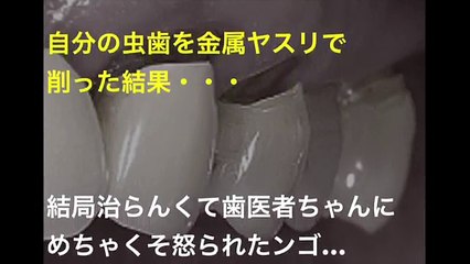 【衝撃】自分の虫歯を金属ヤスリで削った結果、とんでもない事態に・・・