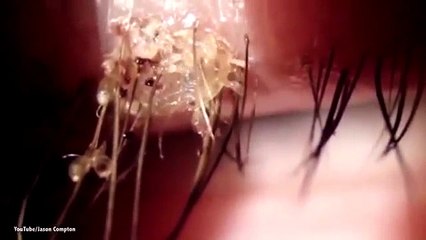 20 con rận trên mắt người phụ nữ