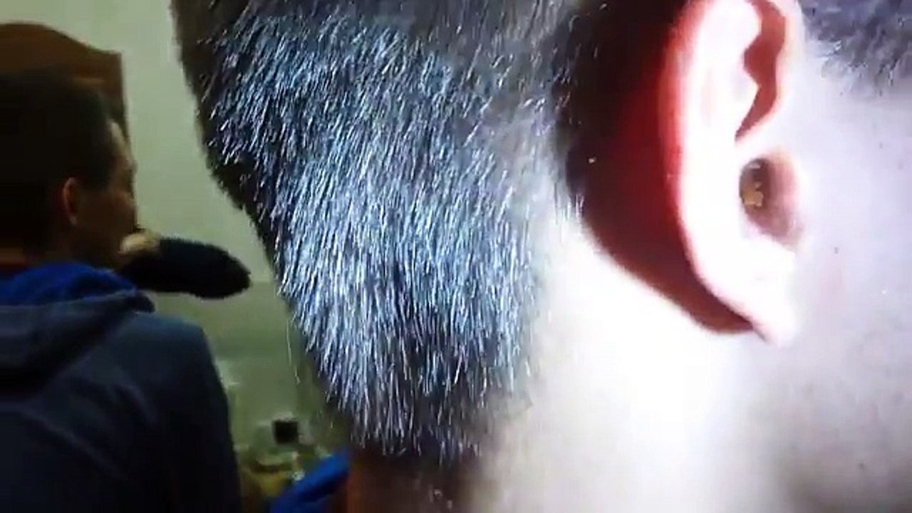 Choáng với cục ráy tai có kích thước khổng lồ được lấy ra từ tai của một người đàn ông