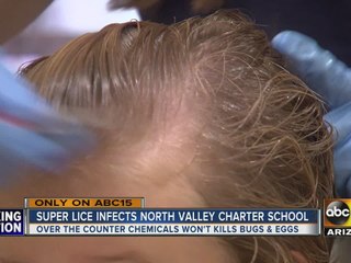 Super lice sweeping through schools in the North Valley