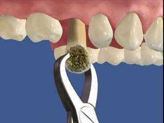 удаление, имплантация, протезирование зубов