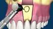 Удаление кисты с сохранением зуба -