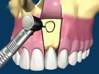 Удаление кисты с сохранением зуба -