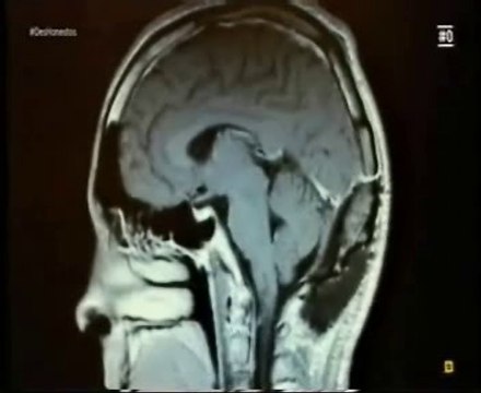 Cerebro: Mentiras piadosas (Teoria de la Mente)
