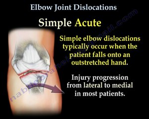 Elbow Dislocations - Everything You Need To Know - Dr. Nabil Ebraheim