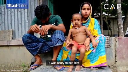 Agé de 4 ans, cet enfant atteint d'une maladie a l'air d'un vieillard