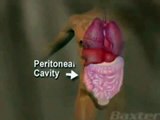 Peritoneal Dialysis for Kidney Disease