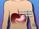 Medical Videos  Hiatal Hernia 3D Medical Animation