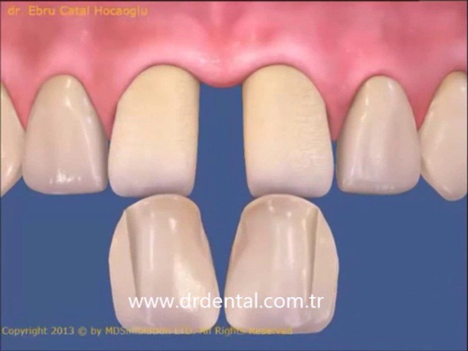 Aralıklı Dişlerin Lamina ile Kapatılması